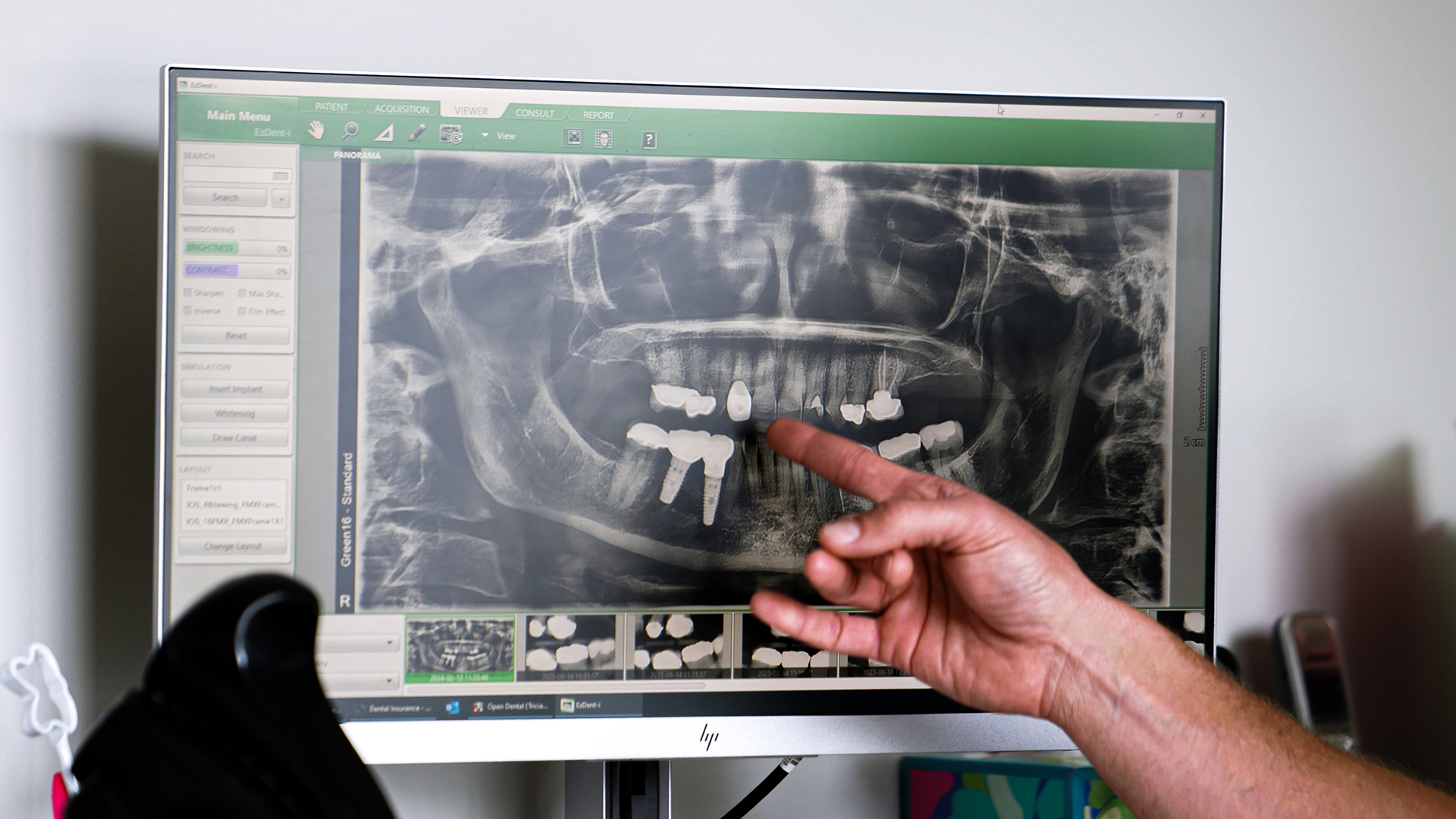 Bone Graft Dentists Hobart Indiana