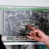 Bone Graft Dentist Hobart In