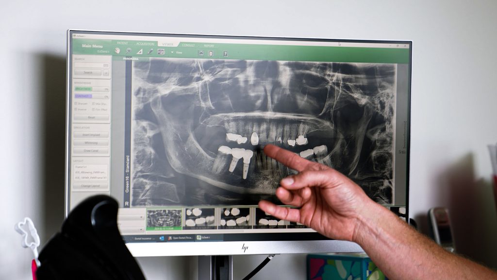 Bone Graft Dentist Hobart In
